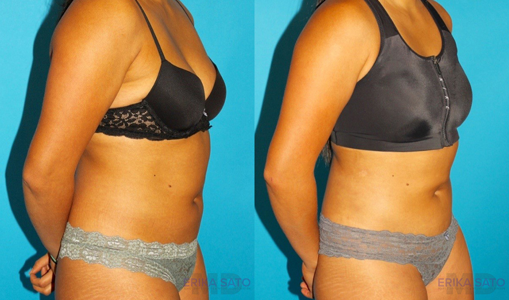 Liposuction case #5890