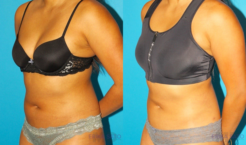 Liposuction case #5890