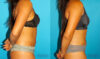 Liposuction case #5890 slider thumbnail