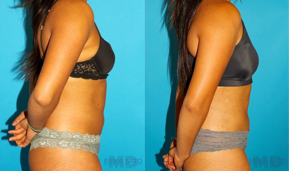 Liposuction case #5890