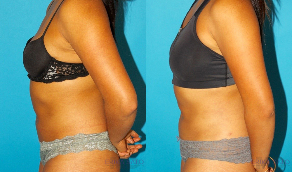 Liposuction case #5890