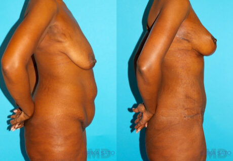 Post Bariatric Surgery (Massive Weight Loss) case #6776