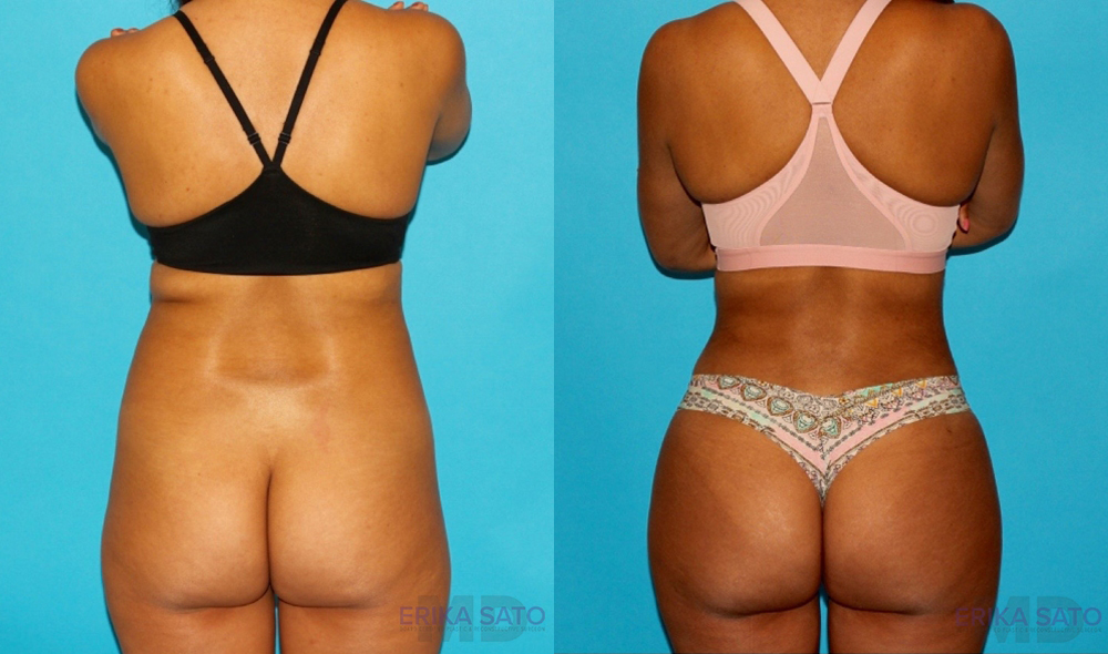 Brazilian Butt Lift case #4765