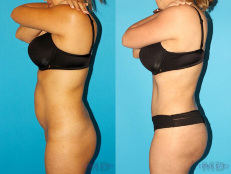 Tummy Tuck case #7340