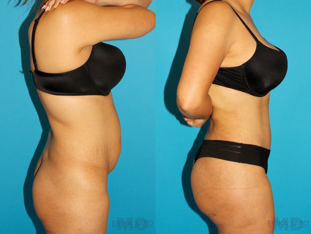 Tummy Tuck case #7340