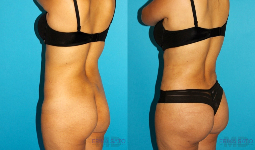 Tummy Tuck case #7340