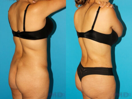 Tummy Tuck case #7340