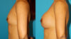 Breast Augmentation case #6250 slider thumbnail