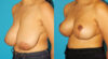 Breast Reduction case #7962 slider thumbnail