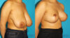 Breast Reduction case #7962 slider thumbnail