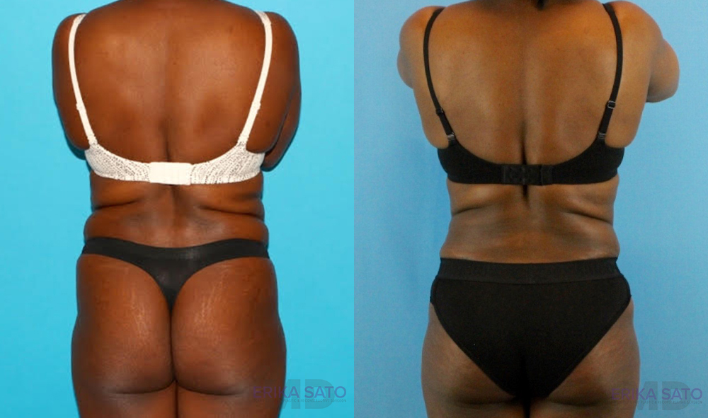 Liposuction case #5891