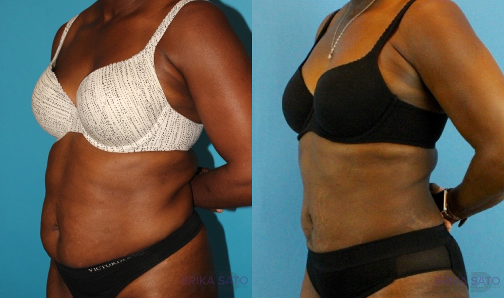 Liposuction case #5891