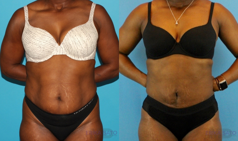 Liposuction case #5891