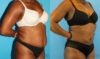 Liposuction case #5891 slider thumbnail