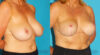 Breast Reduction case #7970 slider thumbnail