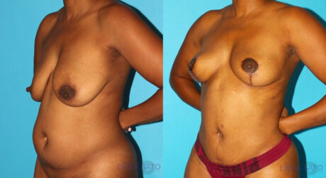 Breast Lift case #6994