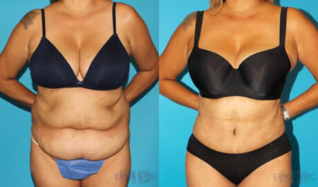 Tummy Tuck case #7170