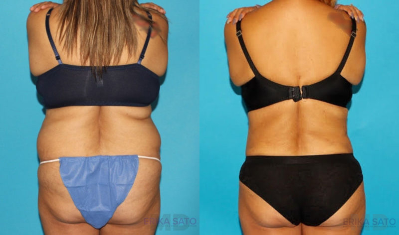 Tummy Tuck case #7170