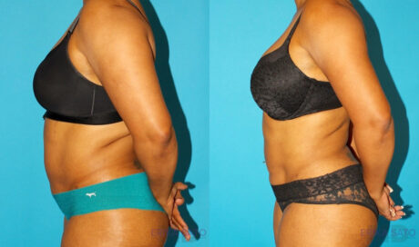 Liposuction case #5894