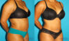 Liposuction case #5894 slider thumbnail