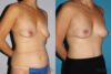 Breast Lift case #6939 slider thumbnail