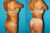 Brazilian Butt Lift case #4616 slider thumbnail