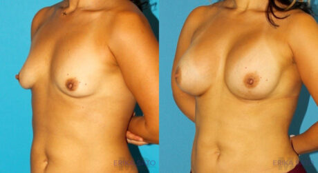 Breast Augmentation case #5632