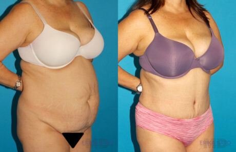 Tummy Tuck case #7171