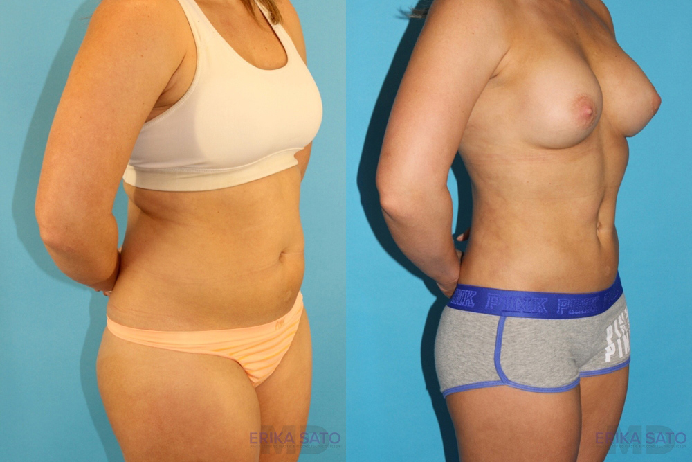 Liposuction case #5883