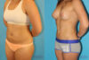 Liposuction case #5883 slider thumbnail