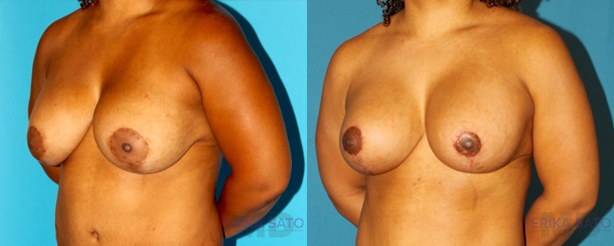 Breast Lift with Implants case #7878