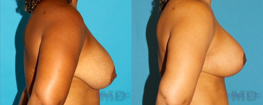 Breast Lift with Implants case #7878