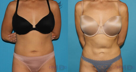 Liposuction case #5839