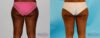 Liposuction case #5837 slider thumbnail