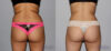 Liposuction case #5836 slider thumbnail