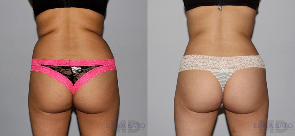 Liposuction case #5836