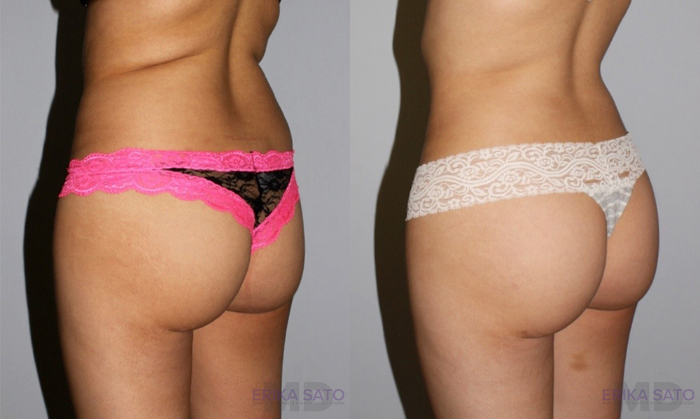 Liposuction case #5836