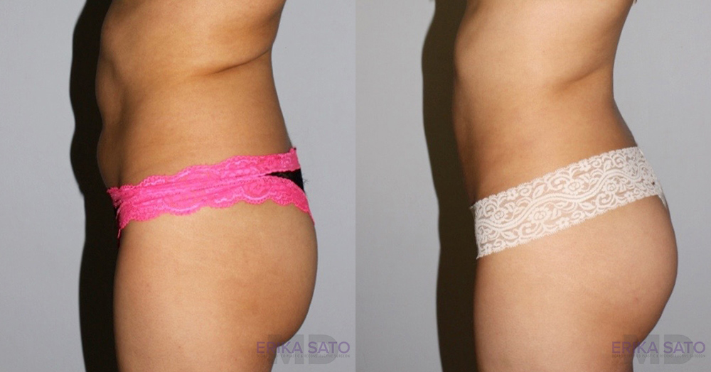 Liposuction case #5836