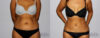 Liposuction case #5835 slider thumbnail