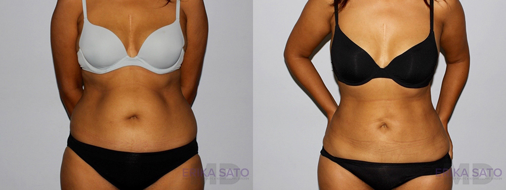 Liposuction case #5835