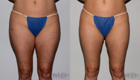 Liposuction case #5832