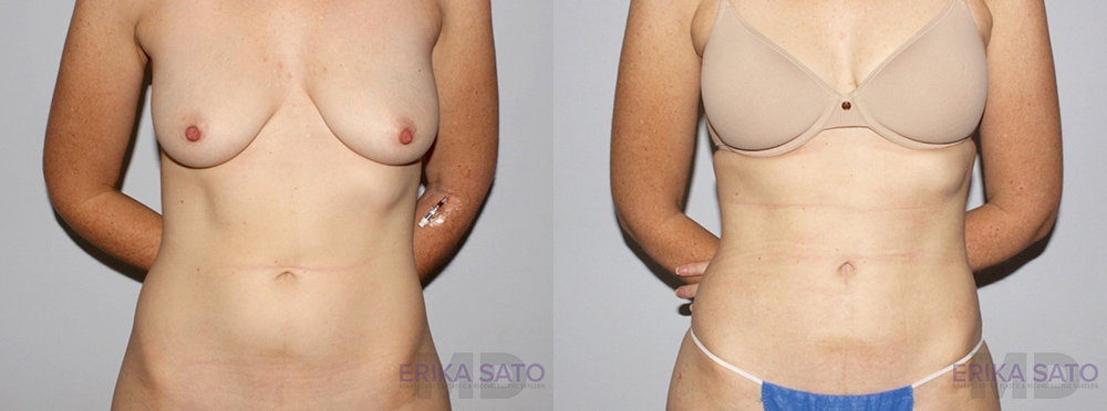 Liposuction case #5831