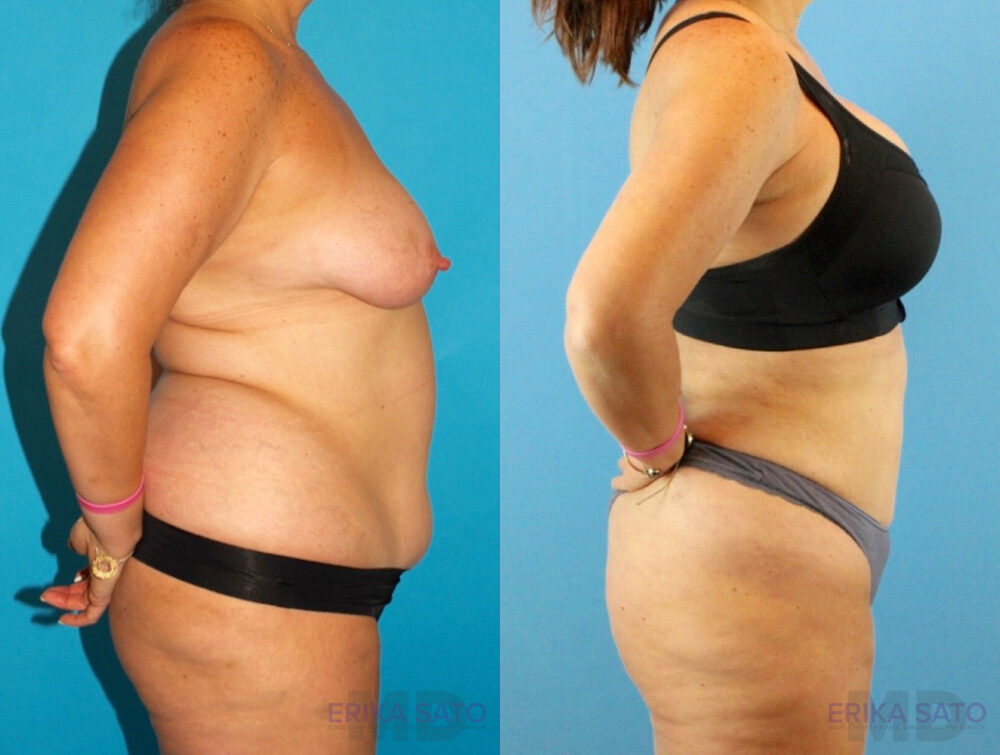 Liposuction case #5964