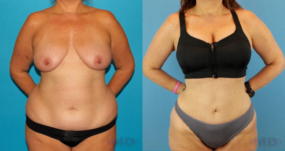 Liposuction case #5964