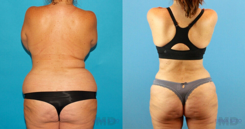 Liposuction case #5964