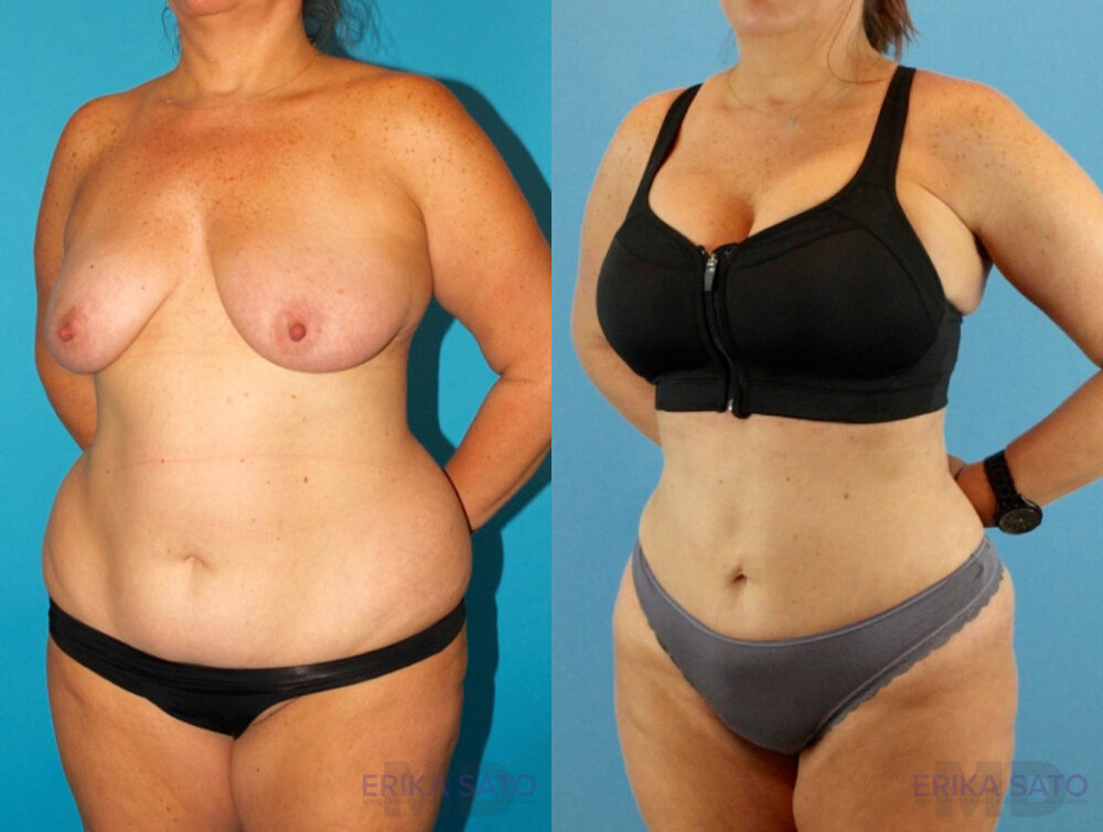 Liposuction case #5964