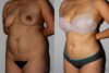 Liposuction case #5830 slider thumbnail