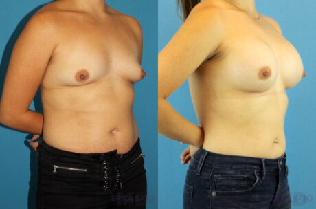 Breast Augmentation case #6262