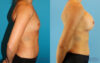 Breast Augmentation case #6273 slider thumbnail