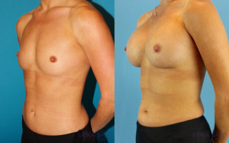 Breast Augmentation case #6273